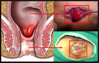 Illustration for article titled Penyakit Wasir Ke Dokter Apa